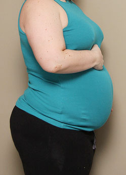 obese pregnant woman